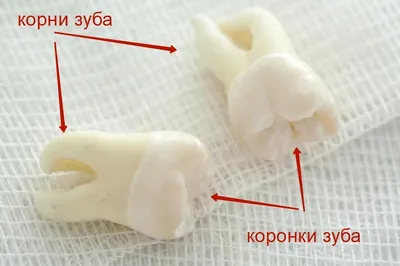 Моя история удаления семи зубов, включая два сверхкомплектных». Рассказ  нашего друга — IMPLANT-IN.COM — дентальная имплантация. естественно.