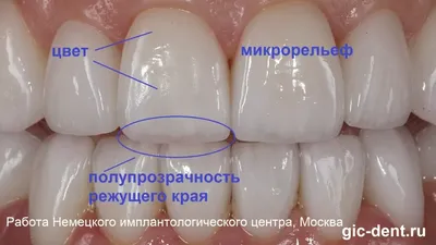 Имплантация и временное протезирование переднего зуба при периодонтите –  Немецкий имплантологический Центр, Москва